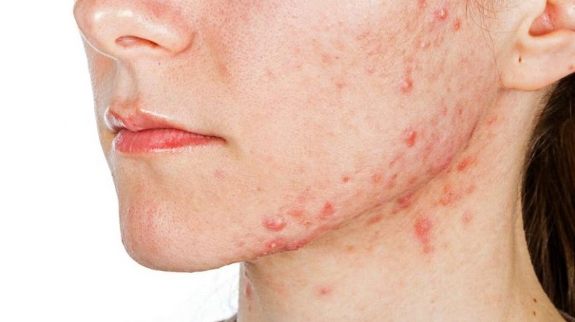 Acne kinds and causes