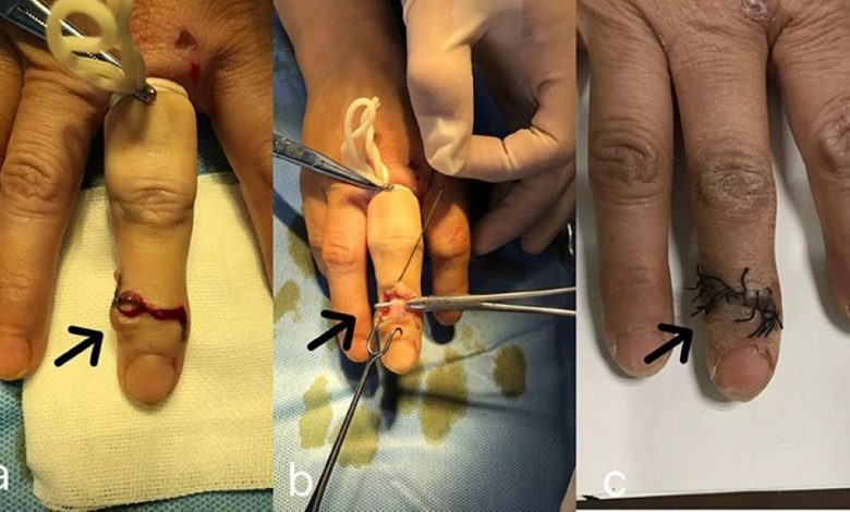 Ovarian cyst removal: Procedure, risk and recovery