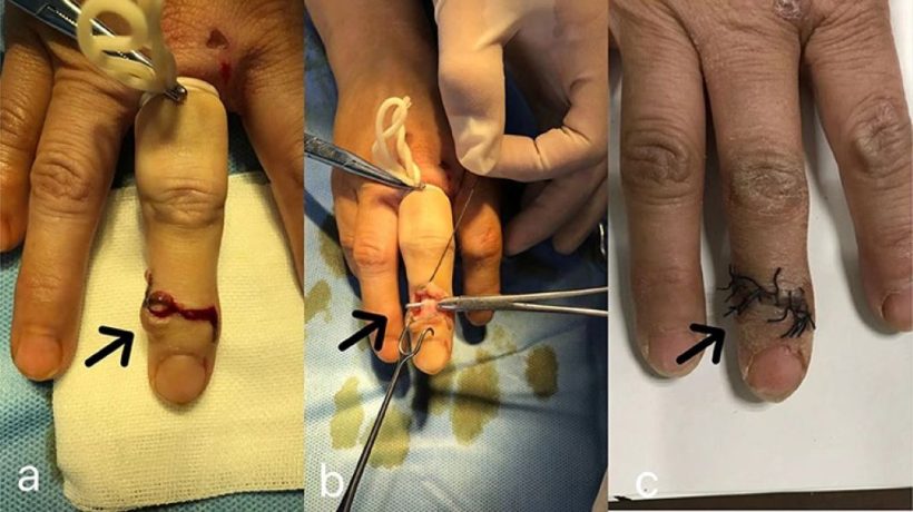 Dermoid Cyst Finger Surgical Removal Recovery Tips